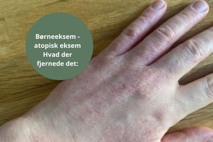 Børneeksem også kaldet atopisk eksem ses her på hånden